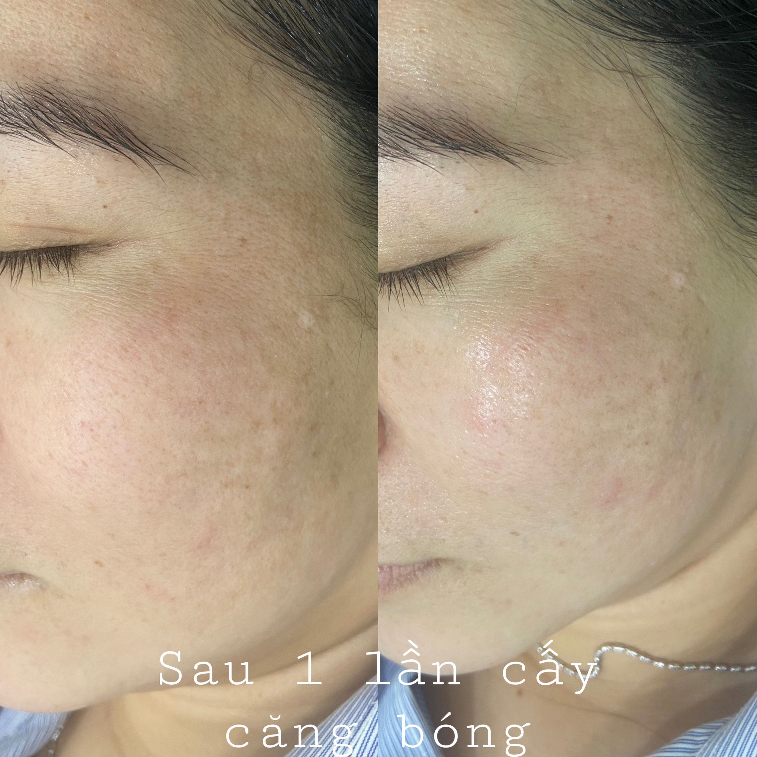 Chăm sóc da cấy lụa trắng sáng