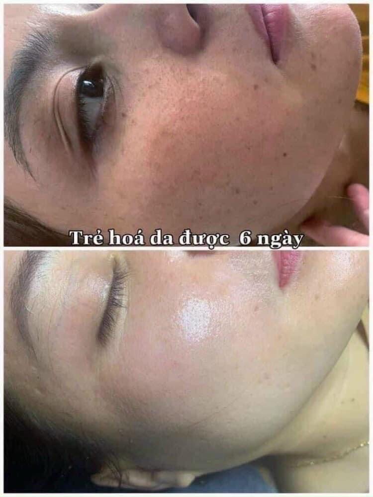 Liệu trình điều trị nám chuyên sâu