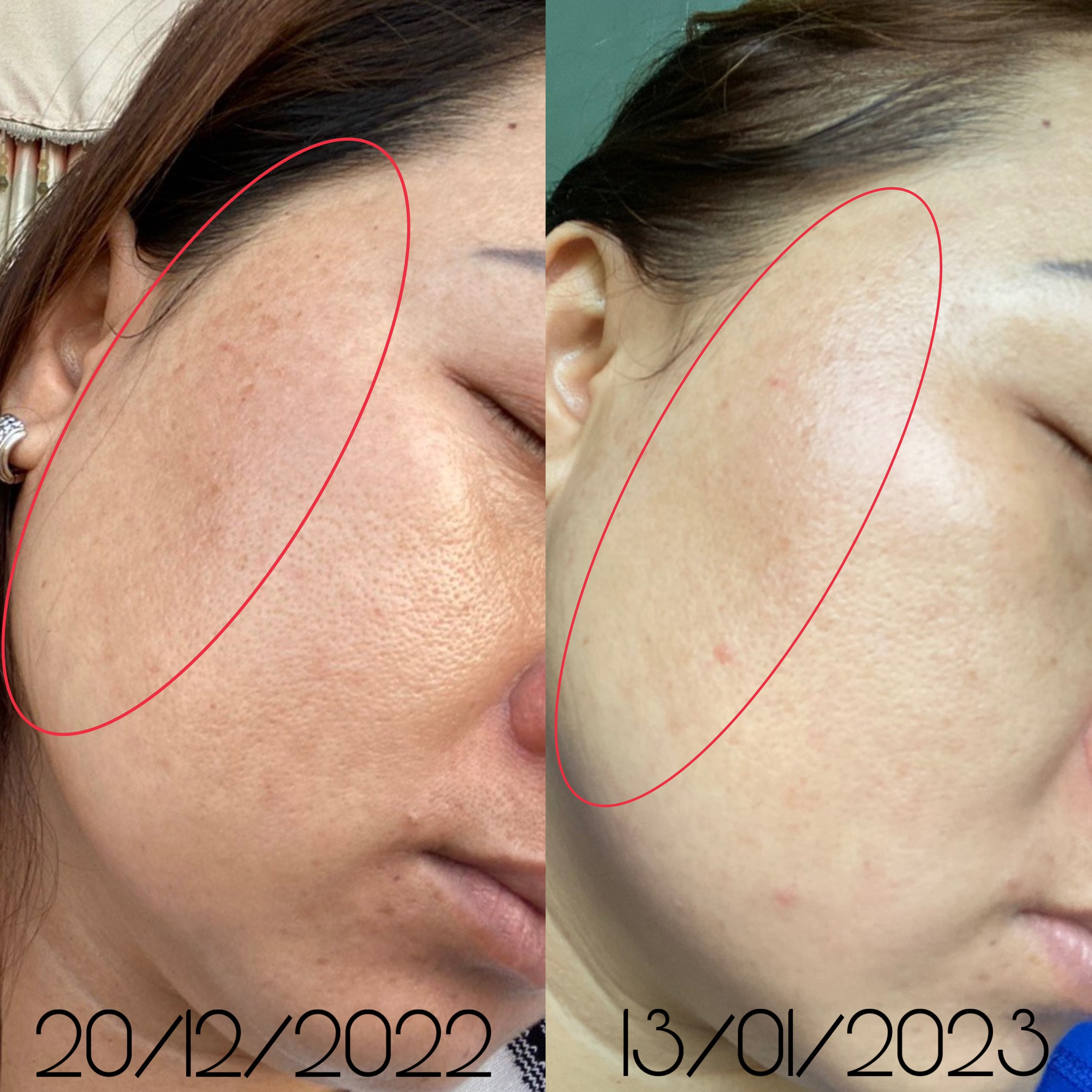 Peel đặc trị nám mảng