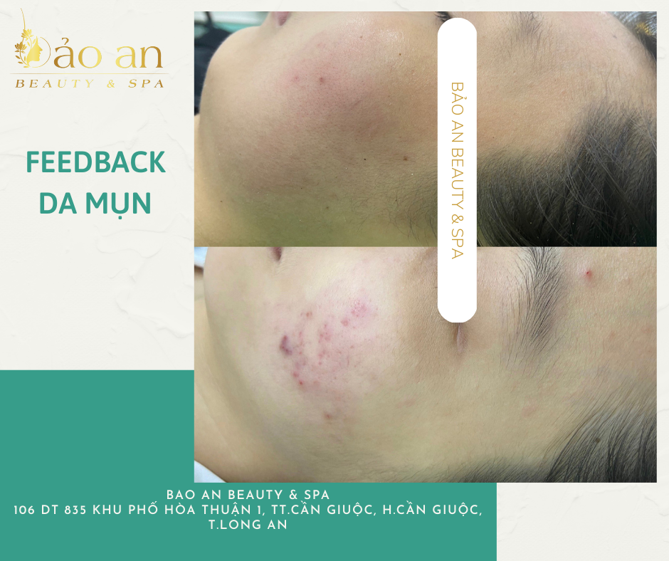 Phác đồ mụn viêm