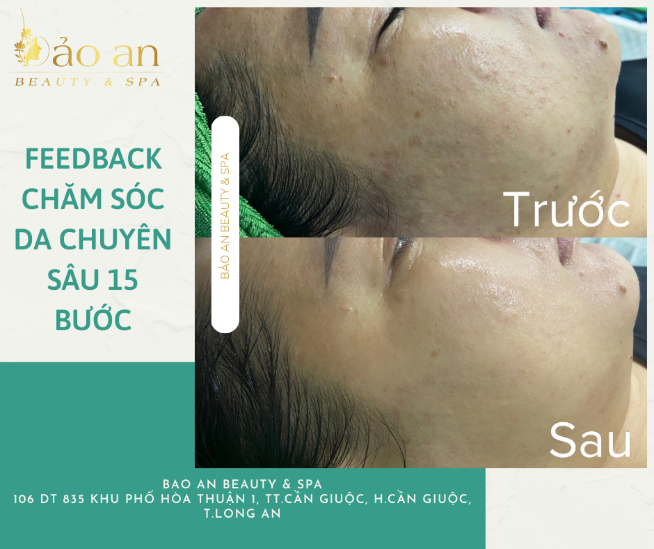 Trị mụn ưu đãi