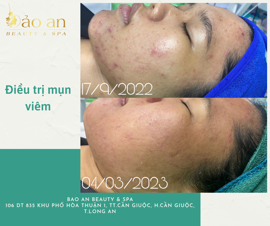 Trị mụn cơ bản